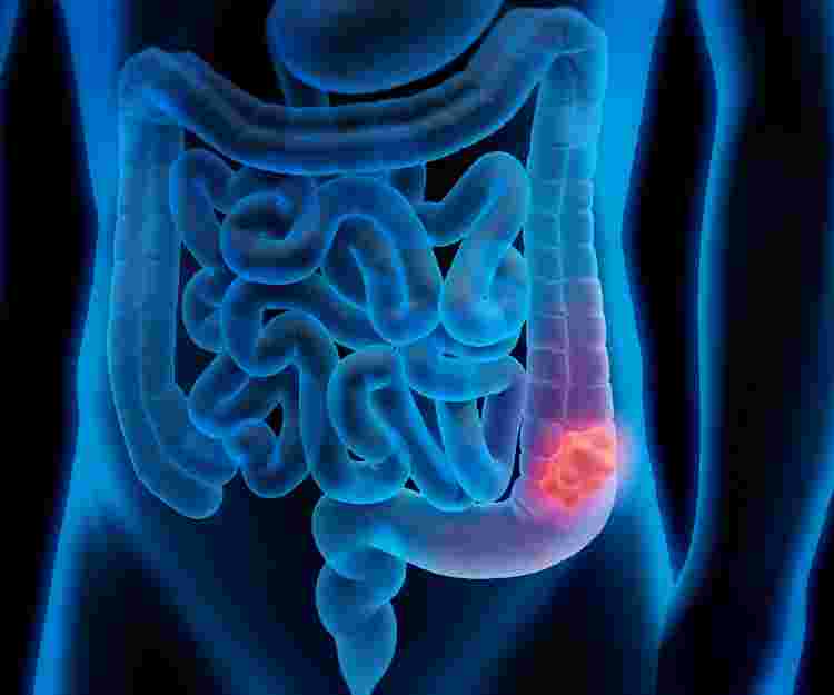 Don’t Delay Colorectal Cancer Screening