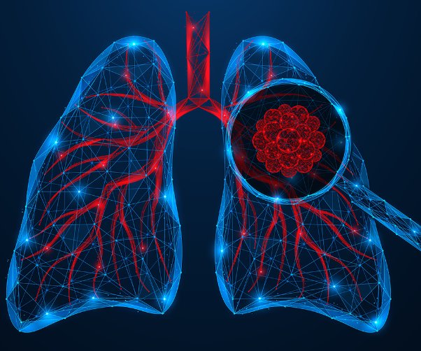 Lung Cancer: Know the Symptoms, Understand Your Risk, and Take Action