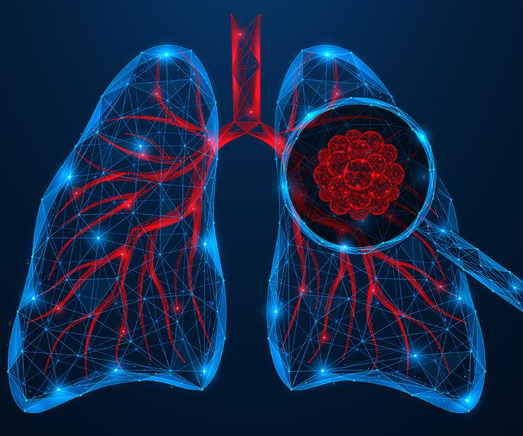 Lung Cancer: Know the Symptoms, Understand Your Risk, and Take Action