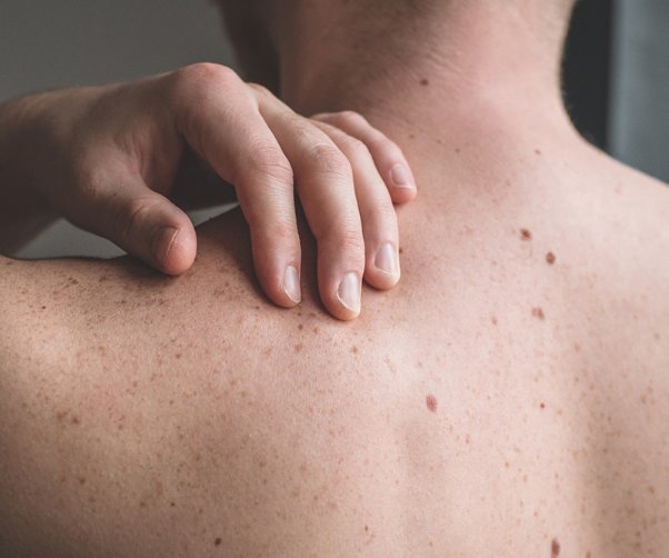 Skin Cancer: Outlining who Is affected, risk factors and how to protect yourself