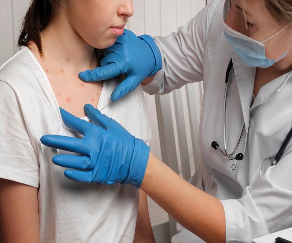 Understanding Measles in Adults