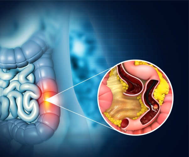 Signs and Symptoms of Colon Cancer