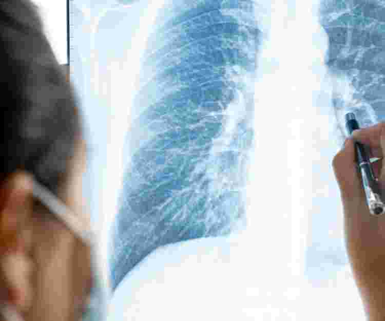 Lung Cancer: Who is at Risk, What are the Symptoms and How to Treat