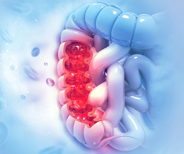 Understanding Colorectal Cancer Risk and Prevention