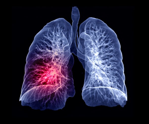 Spots on Your Lungs - What They Mean and How to Treat Them